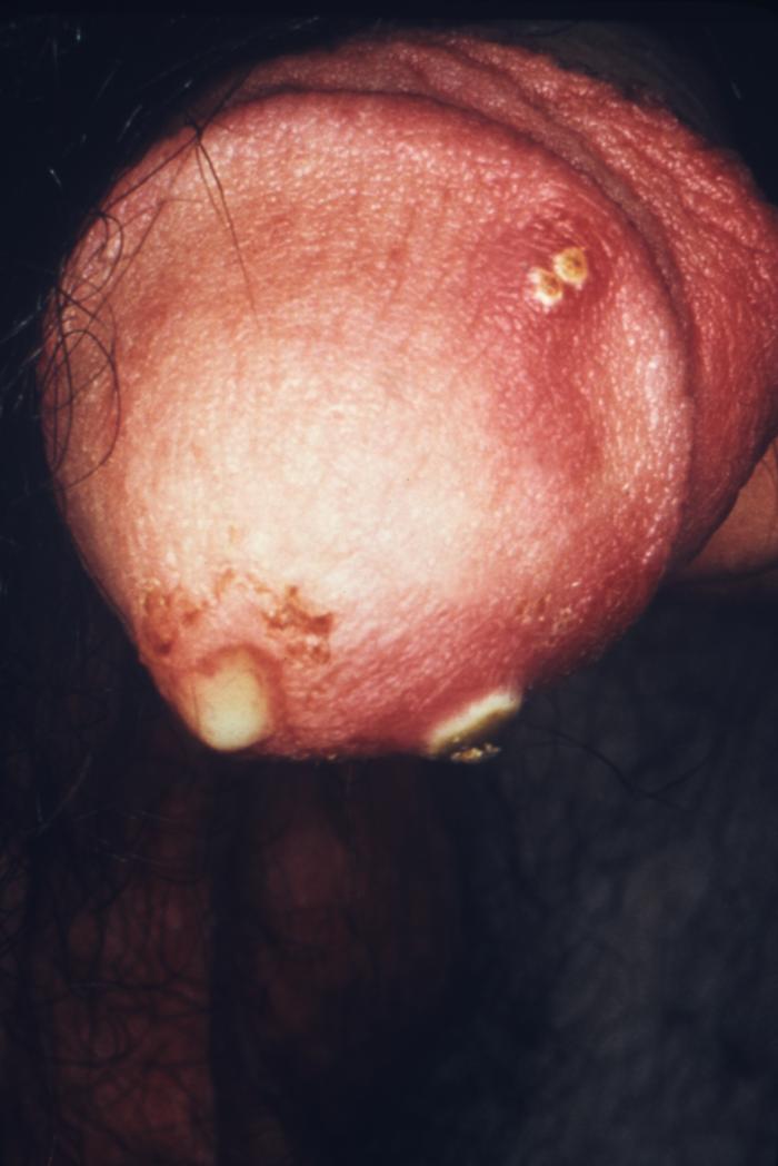 This male presented with a purulent penile discharge due to gonorrhea with an overlying penile pyodermal lesion. Pyoderma involves the formation of a purulent skin lesion, in this case located on the glans penis, and overlying the sexually transmitted disease gonorrhea. Adapted from CDC