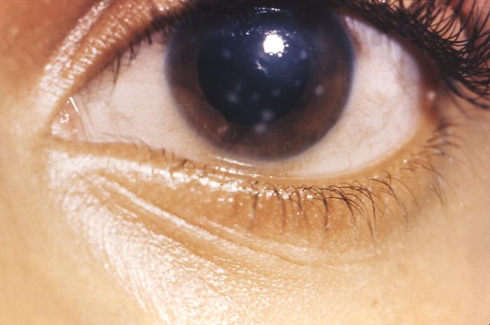 This is an example of interstitial corneal keratitis in a patient with late congenital syphilis. Syphilis is a complex sexually transmitted disease (STD) caused by the bacterium Treponema pallidum. It has often been called "the great imitator" because so many of the signs and symptoms are indistinguishable from those of other diseases. Adapted from CDC