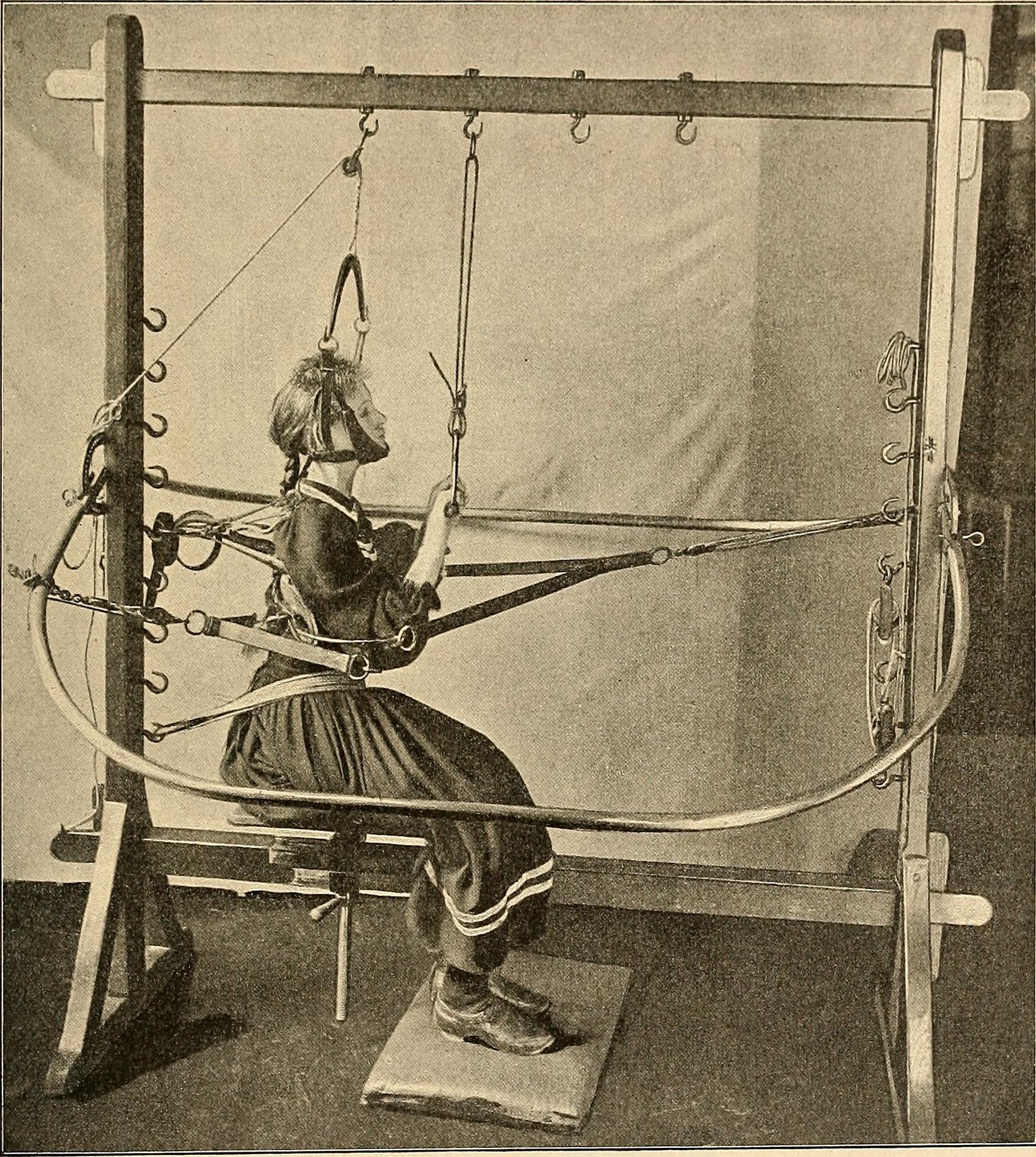 File:Scoliosis Historical Treatment.jpg