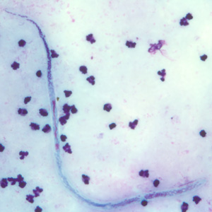 Microfilaria of W. bancrofti in a thick blood smear, stained with Giemsa. Adapted from CDC