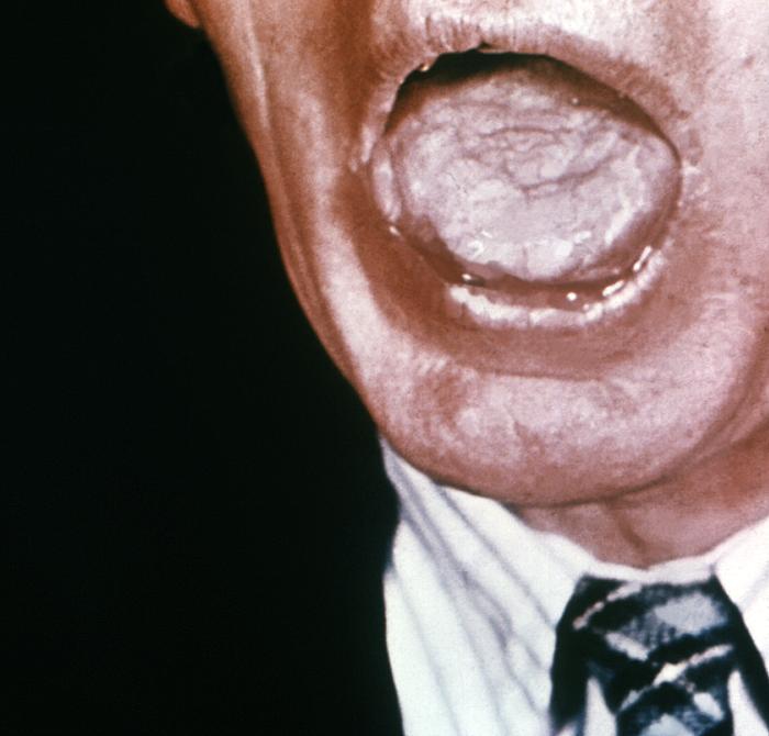 This photograph depicts the a patient’s opened mouth revealing pathologic changes in the superior mucosal surface of his tongue known as syphilitic glossitis, due to a congenital syphilitic infection. Congenital syphilis, is a condition caused by infection in utero with Treponema pallidum. A wide spectrum of severity exists, and only severe cases are clinically apparent at birth. An infant or child (aged less than 2 years) may have signs such as hepatosplenomegaly, rash, condyloma lata, snuffles, jaundice (nonviral hepatitis), pseudoparalysis, anemia, or edema (nephrotic syndrome and/or malnutrition). An older child may have stigmata (e.g., interstitial keratitis, nerve deafness, anterior bowing of shins, frontal bossing, mulberry molars, Hutchinson teeth, saddle nose, rhagades, or Clutton joints). Adapted from CDC