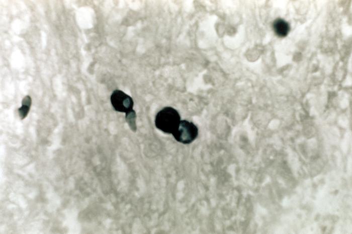 Note the histopathologic changes seen in blastomycosis due to Blastomyces dermatitidis using methenamine silver stain.From Public Health Image Library (PHIL). [26]