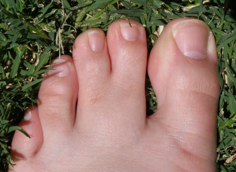 ashton kutcher webbed toes