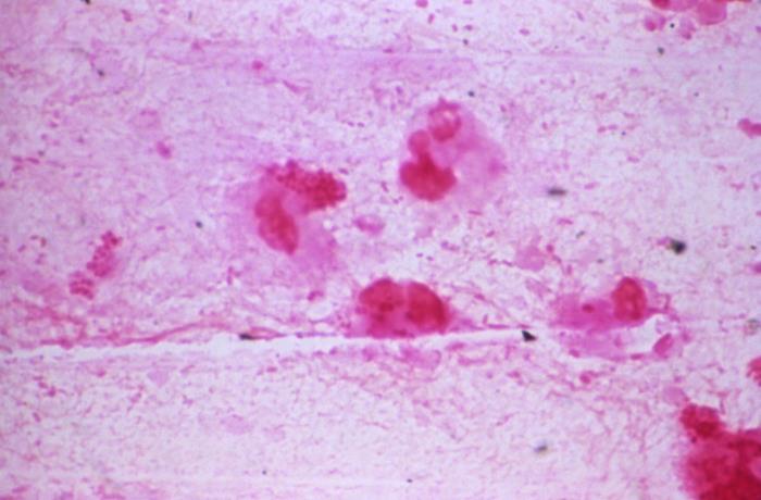 Photomicrograph (1000X mag) reveals Gram-negative rods, and Gram-negative cocci, which were determined to be Haemophilus influenzae, and non-meningococcal Neisseria sp. organisms respectively. From Public Health Image Library (PHIL). [6]