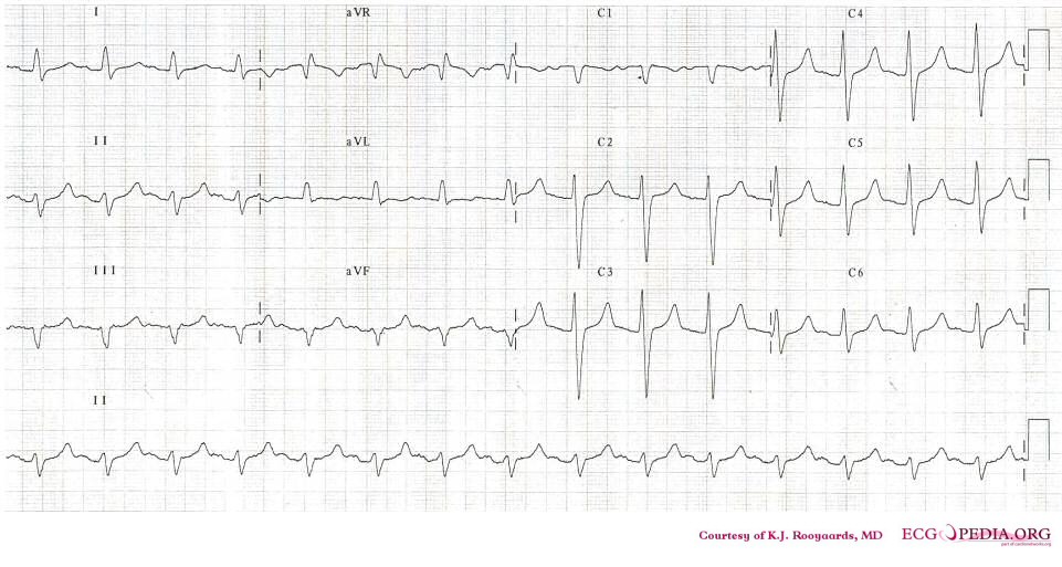 Consecutive ECGs of a patient with hypokalemia. After correction of potassium levels.