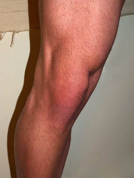 Male knee