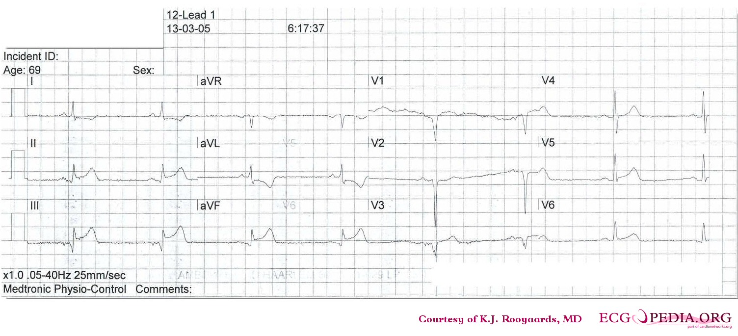 Sinus bradycardia with inferior-lateral myocardial infarction.