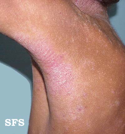 File:Atopic Dermatitis09.jpg