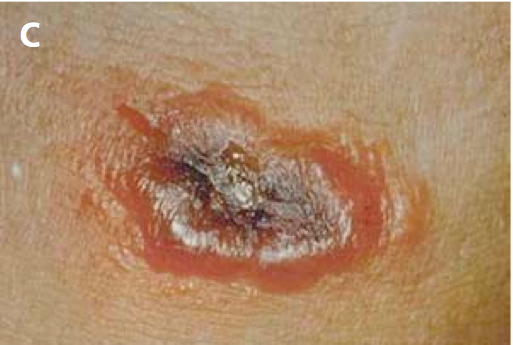 Day 4 of development and resolution of uncomplicated cutaneous anthrax lesion.”Adapted from World Health Organization (WHO)[2]