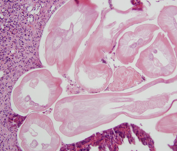Cross-sections of Dirofilaria spp. from a subcutaneous scalp nodule, stained with H&E. Image courtesy of the Department of Dermatopathology, University of Michigan, Ann Arbor, MI. Adapted from CDC