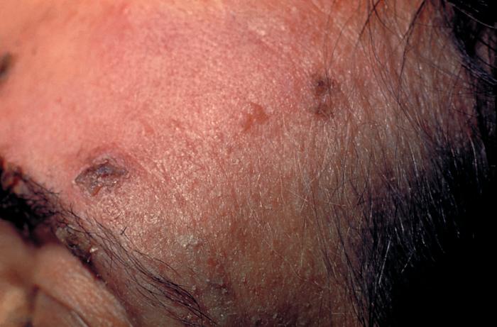 File:Herpes zoster 14.jpg