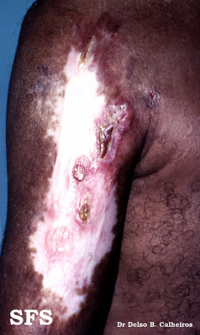 Lupus vulgaris. Adapted from Dermatology Atlas.[5]