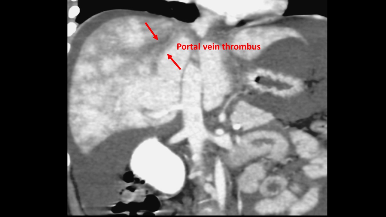 File:Pvt ct axial.JPG
