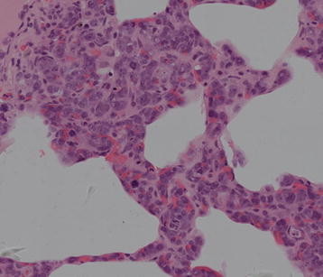 Hematoxylin-eosin staining of pulmonary interstitium intravascular lymphoma (400X),the the alveolar septae was widen and filled with tumour cells showed in high power field.[2]