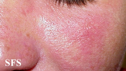 File:Nail polish dermatitis11.jpg