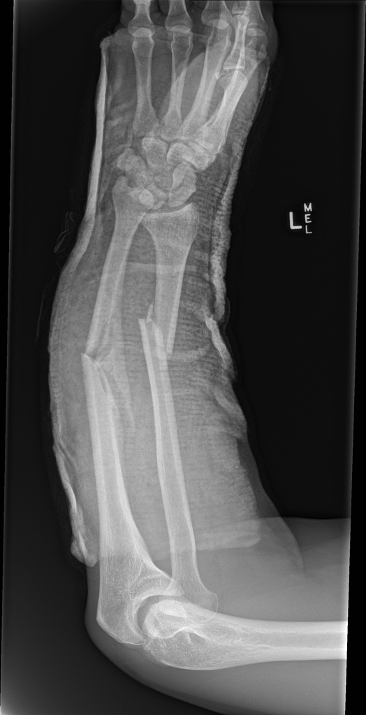 Combined Monteggia and Galeazzi fractures- Short arm backslab. Ulnar and radial midshaft fractures maintain similar alignment. Dorsally dislocated ulnar head (DRUJ). Volarly dislocated radial head (PRUJ) confirmed.