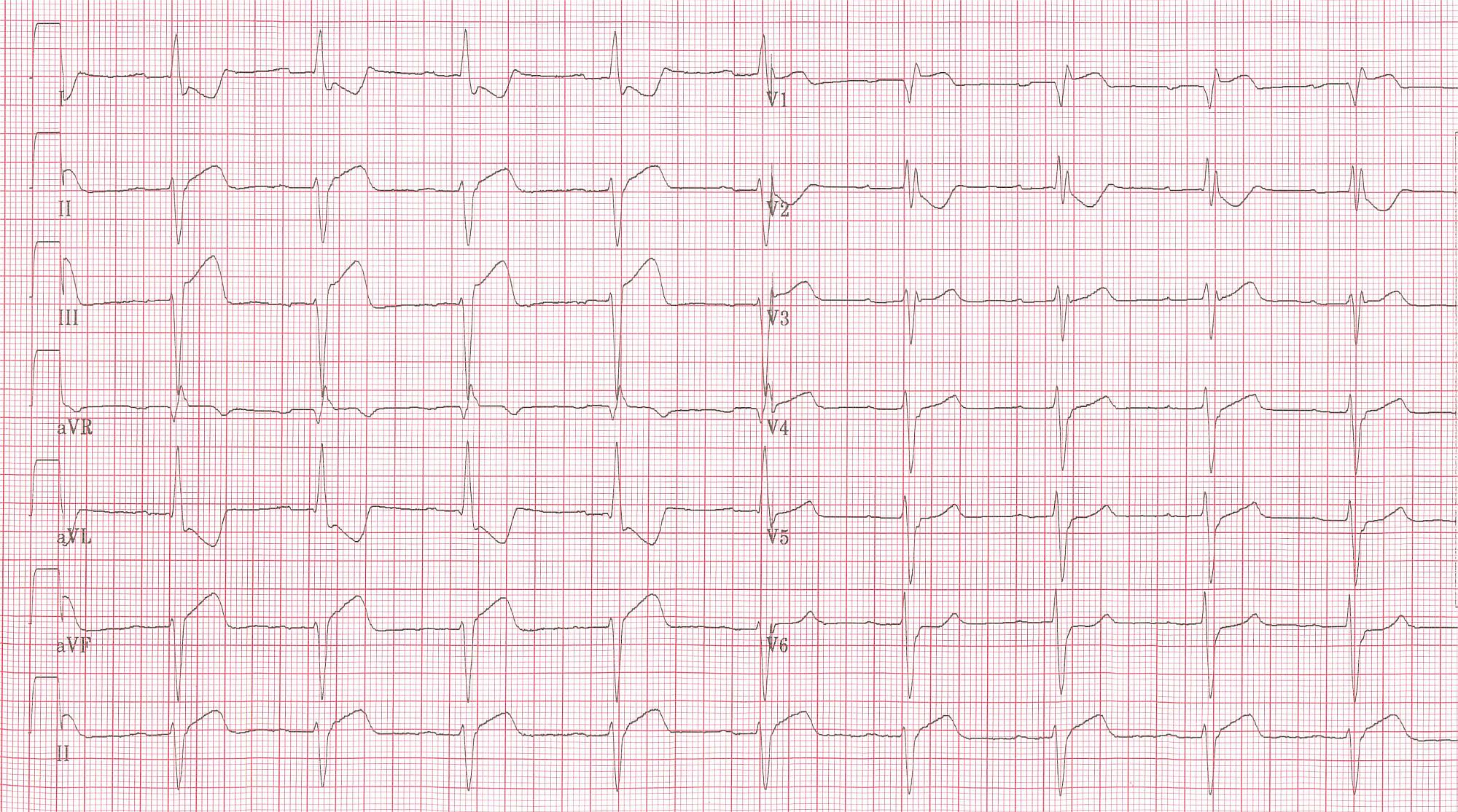 Patient with RBBB and inferior MI. Note to left axis deviation.