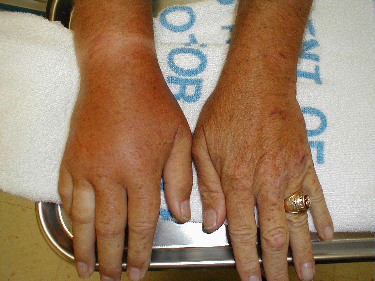 Gout of the Right Wrist: Note swelling and redness over right wrist area. Left wrist is normal.