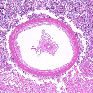 Transverse section through the body wall of Bolbosoma sp. in an intestinal biopsy specimen, stained with H&E. Image taken at 100x magnification. In this image, a portion of the reproductive system is visible within the pseudocoelom. Adapted from CDC