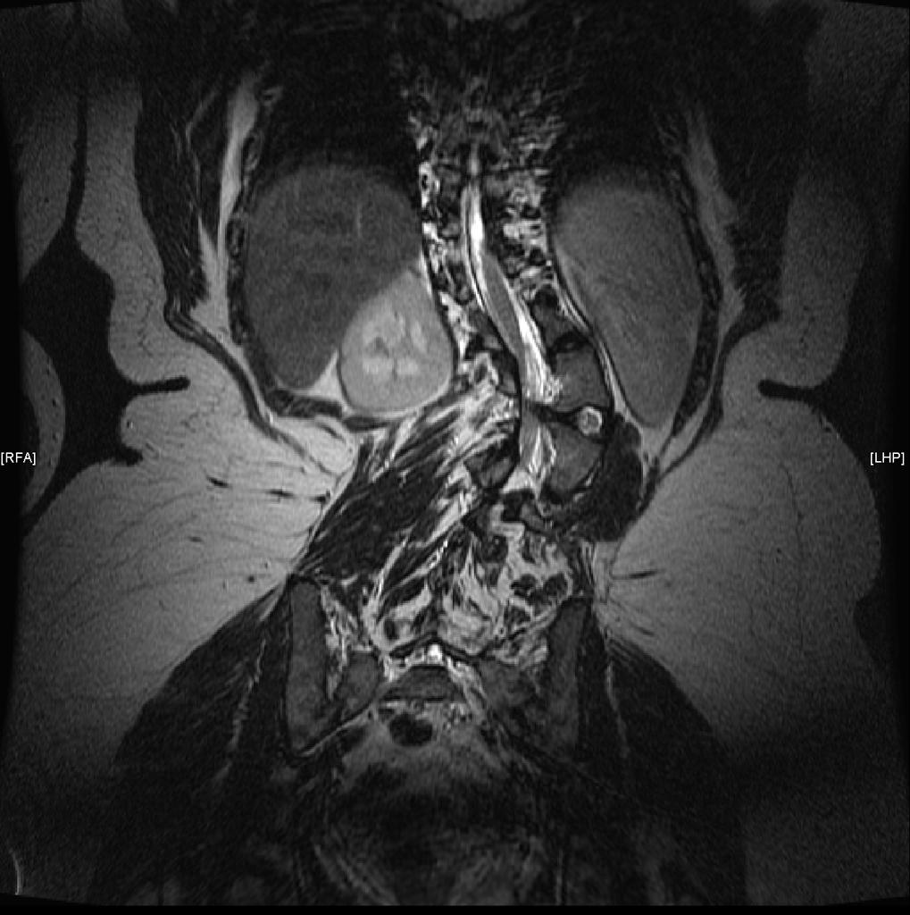 File:MRI hemivertebra with congenital-scoliosis.jpg