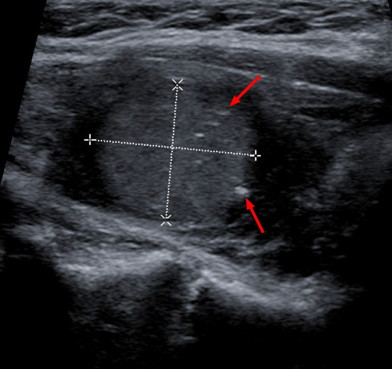 File:Medullary thyroid carcinoma on ultrasound.jpg