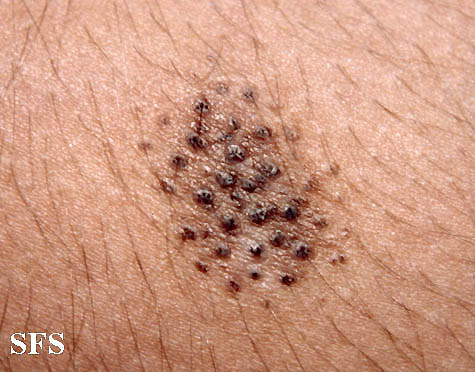 Naevus comedonicus. Adapted from Dermatology Atlas.[4]