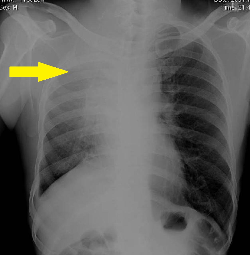 Pancoast tumor chest x ray - wikidoc
