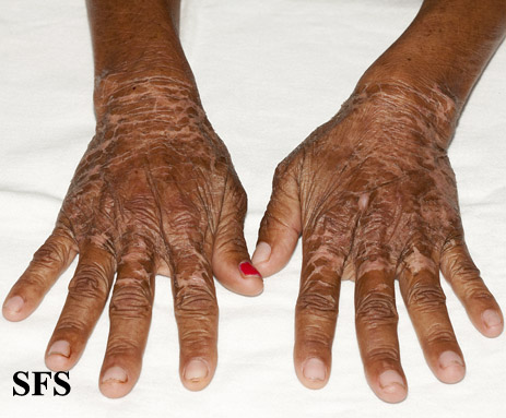 Pellagra. With permission from Dermatology Atlas.[7]