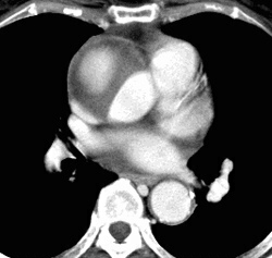 File:Aortic dissection.jpg