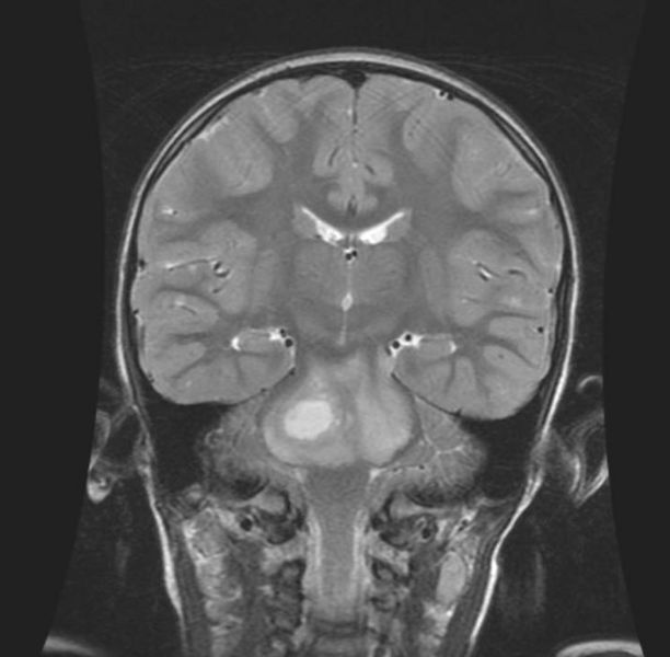File:Brainstem-glioma-002.jpg