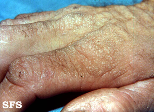 Colloid milium. Adapted from Dermatology Atlas.[2]</SMAL