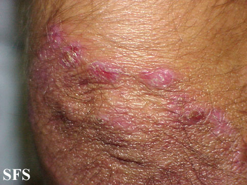 File:Dermatitis herpetiformis20.jpg
