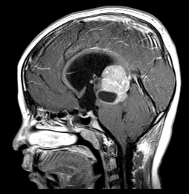 Sagittal MRI with contrast demonstrating a large enhancing mass centered on the pineal region. It is heterogeneous with areas of cystic change. There is marked compression of the tectum with resulting obstructive hydrocephalus. A little surrounding edema is also present.[19]