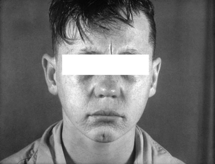 Photograph of rhagades resulting from congenital syphilis. This patient with congenital syphilis is exhibiting rhagades, which are cracks or fissures in the skin around the mouth. Such a rare type of facial disfigurement, results from persistent infantile syphilitic rhinitis. Adapted from CDC