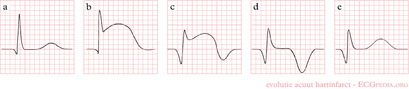 The evolution of an infarct on the ECG. ST elevation, Q wave formation, T wave inversion, normalization with a persistent Q wave