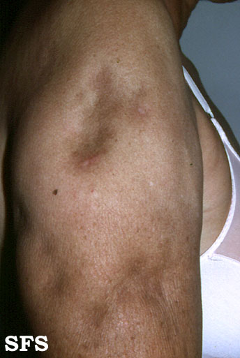 Lupus erythematosus profundus. Adapted from Dermatology Atlas.[6]