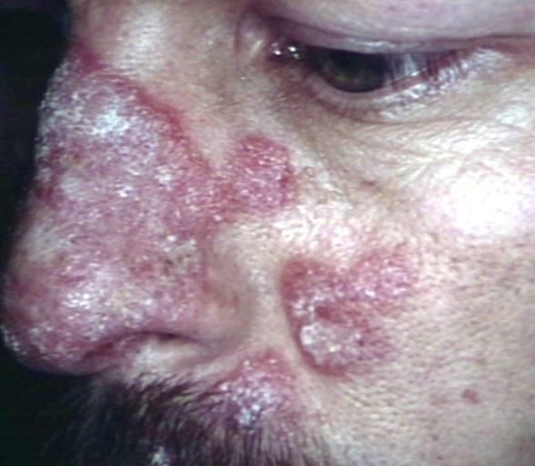Skin: discoid lupus, face