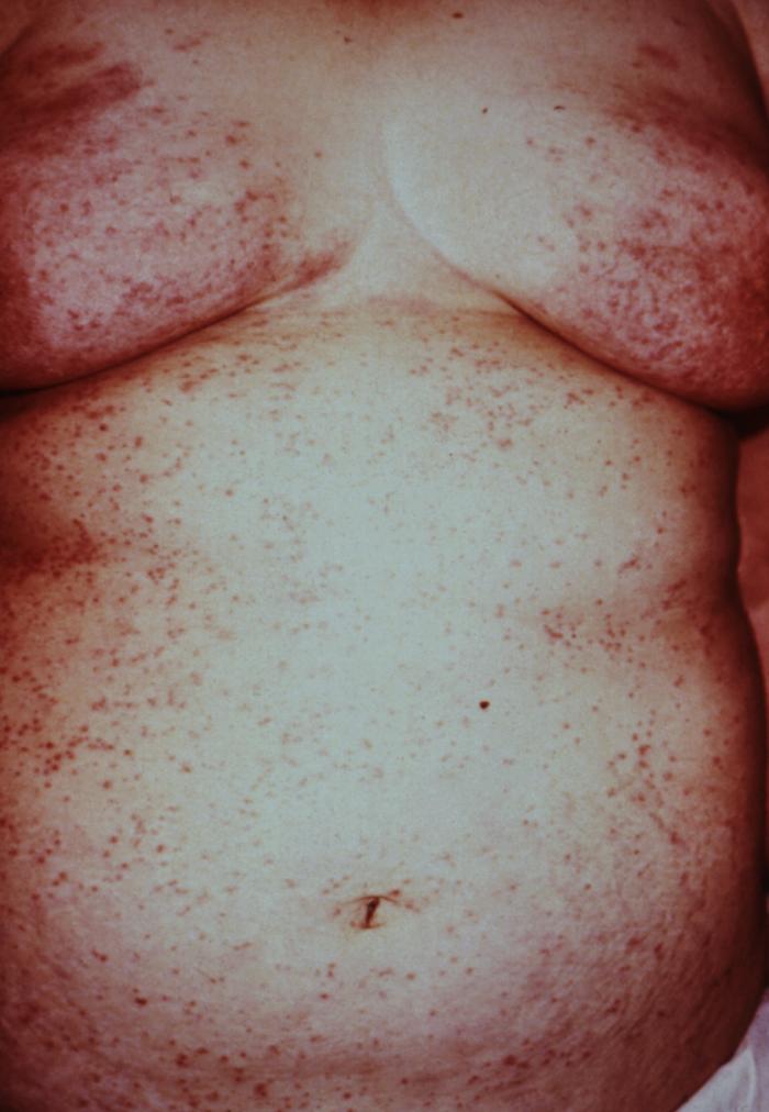 This woman presented with a rash composed of pimple-like irritations on the abdomen and thorax due to canine scabies. If an animal is infested with scabies, or mange, and comes in close contact with humans, the mites can get under the skin causing itching and irritation. However, this form of scabies is mild, and the mites die in a couple of days without reproducing. Adapted from CDC