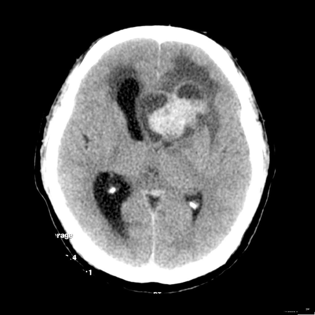 File:Ependymoma-lateral-ventricle.jpg
