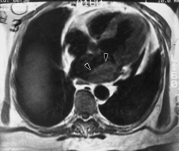 Axial T1-weighted MRI shows a soft tissue mass within the left atrium isointense to skeletal muscle (arrowheads). A friable myxoma was removed from the left atrium of a 53-year-old man with cerebrovascular accidents.