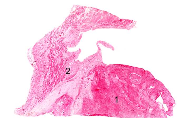 This is a low-power photomicrograph of the thrombus (1) attached to the myocardium (2).