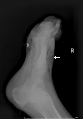 Gas is observed on X-ray of the foot of a patient with diabetes(Image courtesy of Biomed Central)