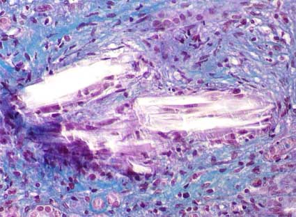Medullary interstitial urate crystal deposits in chronic nephropathy by urates as seen after Masson's trichome stain X400[21]