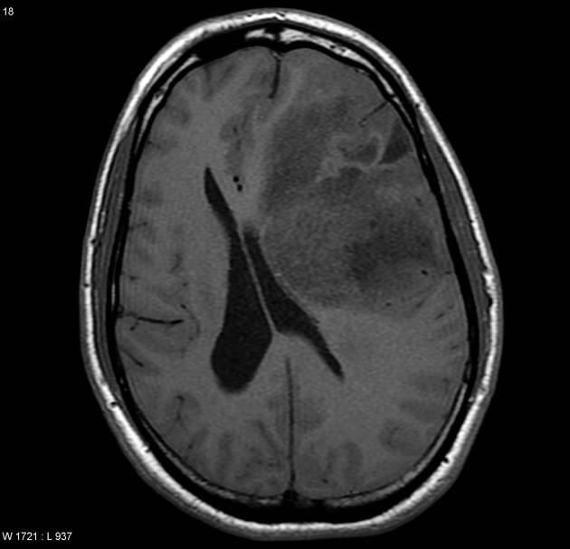 File:Anaplastic oligoastrocytoma MRI T1.jpg