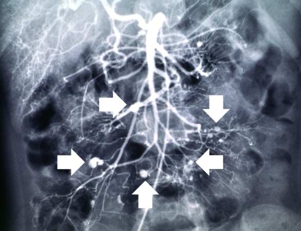 This angiogram of the abdominal viscera demonstrates numerous aneurysms throughout the mesenteric circulation (arrows).