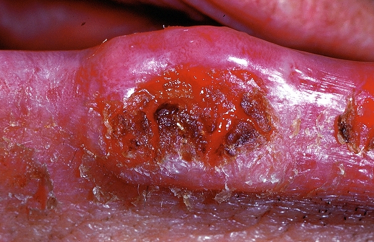 File:Squamous cell carcinoma oral 003.jpg