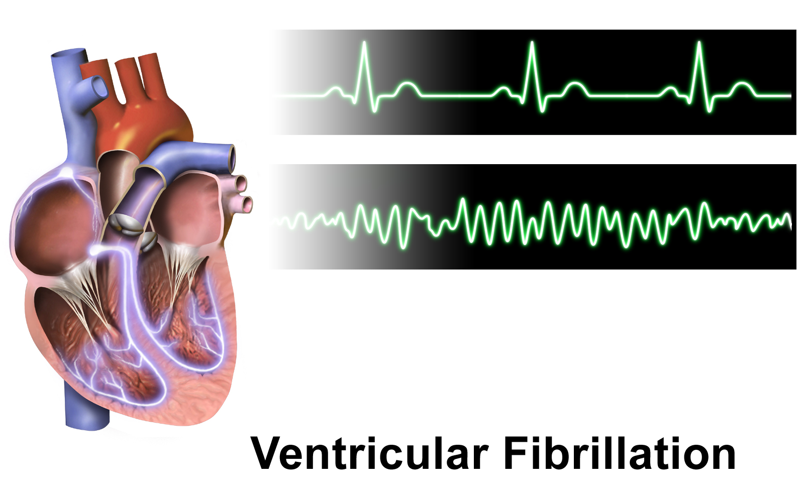 File:Ventricular Fibrillation.png