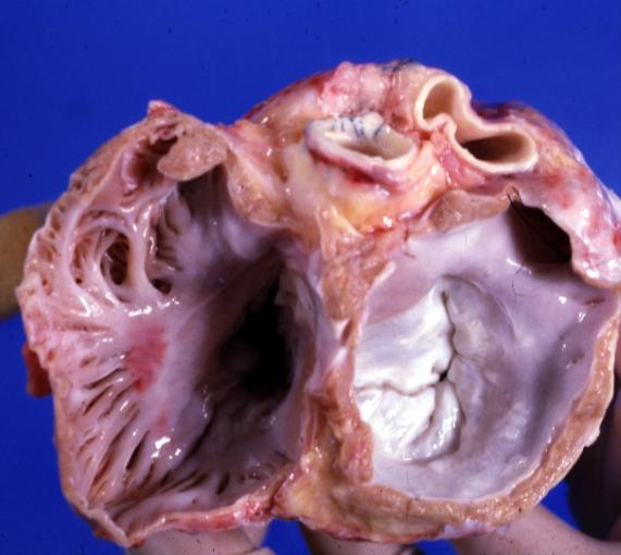 Cardiomyopathy: Gross excellent view of mitral and tricuspid valves from atria, appear normal anatomy.