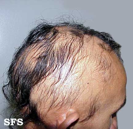 File:Alopecia areata 05.jpeg