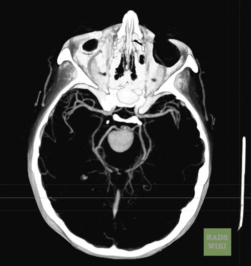 CT: A large basilar artery aneurysm